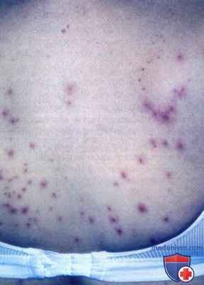 Фолликулит