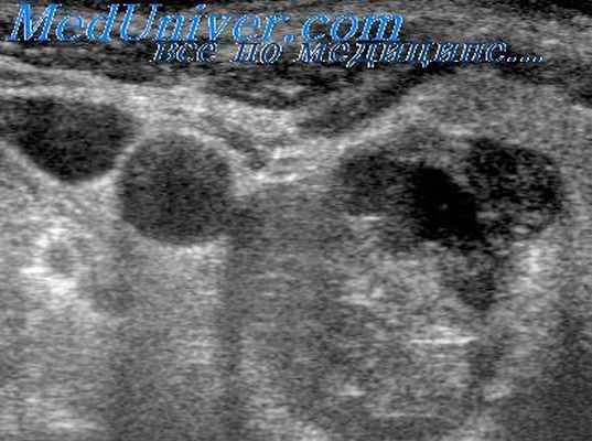 аденома щитовидной железы