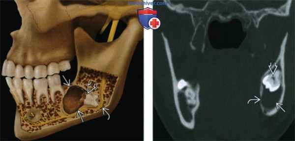Фолликулярная киста челюсти - лучевая диагностика