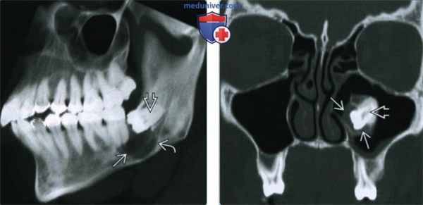 Фолликулярная киста челюсти - лучевая диагностика