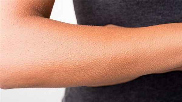 Фолликулярный кератоз у взрослых