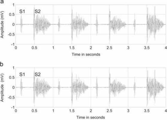 фонокардиограмма пациента