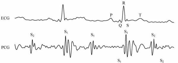 фонокардиограмма пациента
