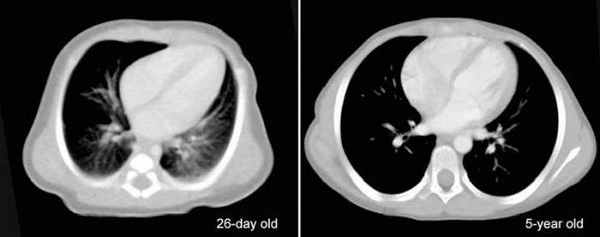 Нормальная конфигурация сердца