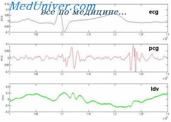 фонокардиография