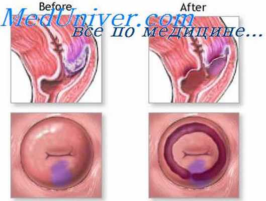 болезни шейки матки