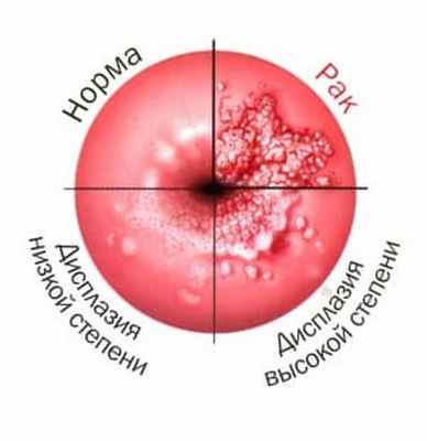Заболевания шейки матки 1.jpg