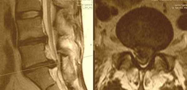 медианная грыжа диска