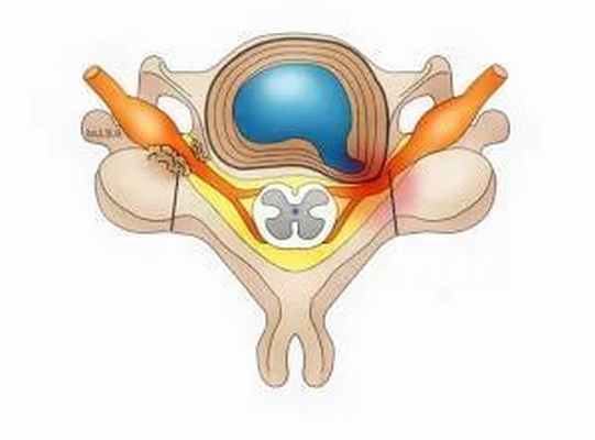 Фораминальная грыжа диска