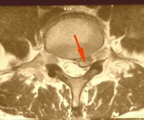 латеральная грыжа диска