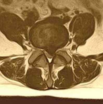 Парамедианная грыжа диска