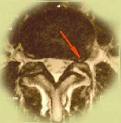 фораминальная грыжа диска