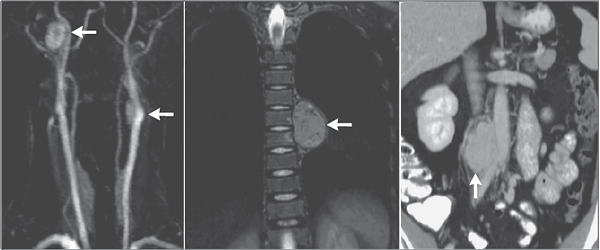 Феохромоцитома и параганглиома