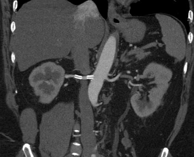 Реноваскулярная гипертензия