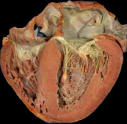гипертрофия левого желудочка при гипертонической болезни