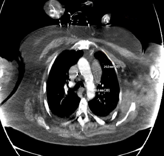 Синдром Кушинга