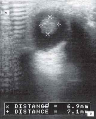 Небольшой ретинобластом