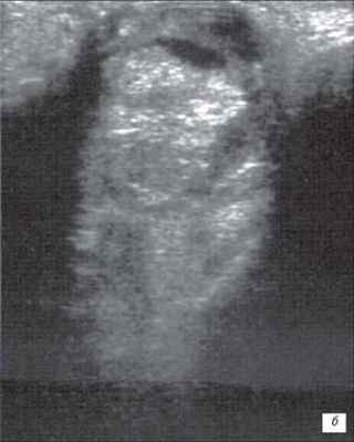 Большой ретинобластом