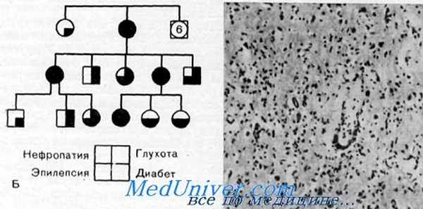 фотомиоклонус