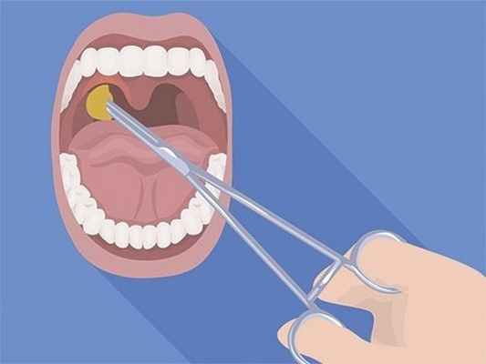 Чем отличаются аденоиды от миндалин, и нужно ли их удалять