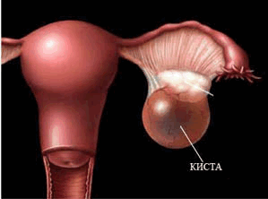 Киста яичника