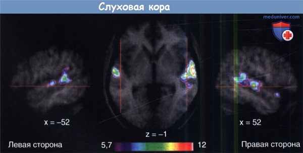 Слуховая кора