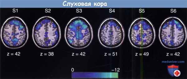 Слуховая кора