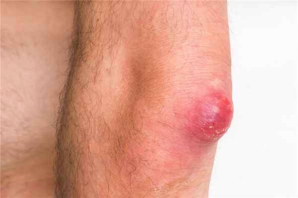 Карбункулы на руке