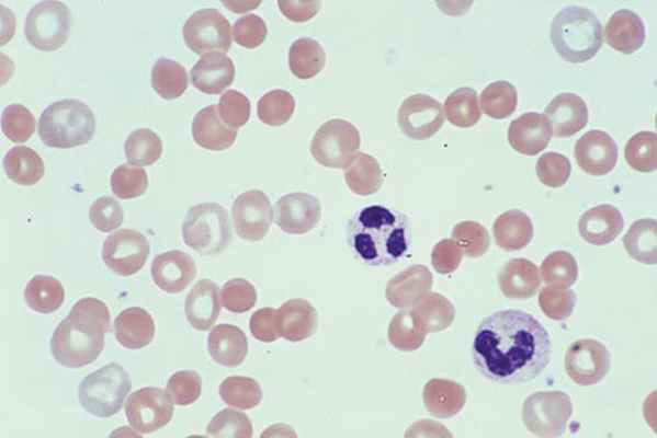 Обзор гемолитической анемии (Overview of Hemolytic Anemia)