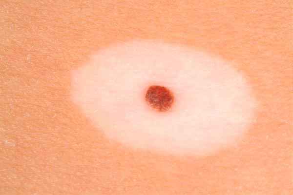 невус Сеттона