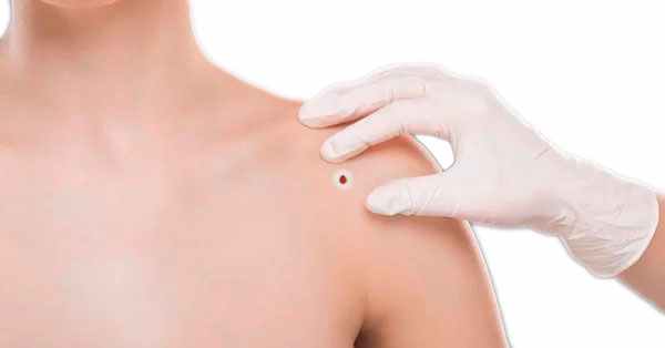 Невус Сеттона