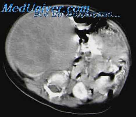 термография