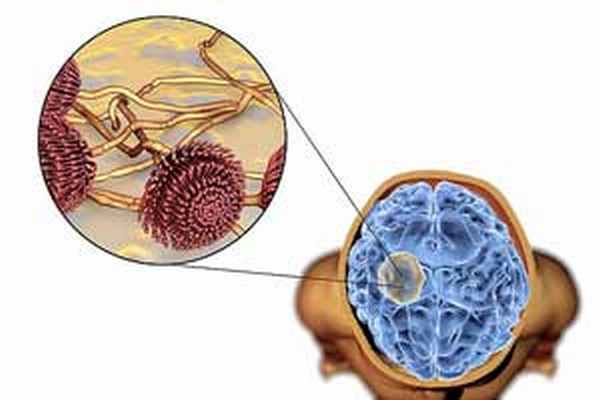 ганглионейробластома