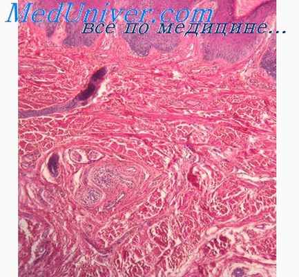 бактериальный эндокардит