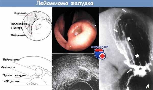 Лейомиома желудка