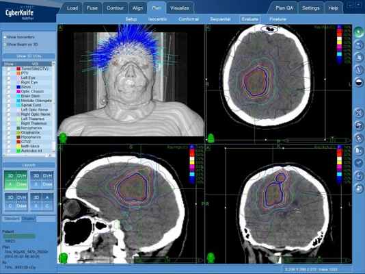 Гемангиобластома - лечение на КиберНоже