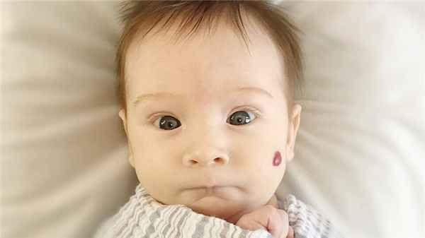 Гемангиома у ребенка