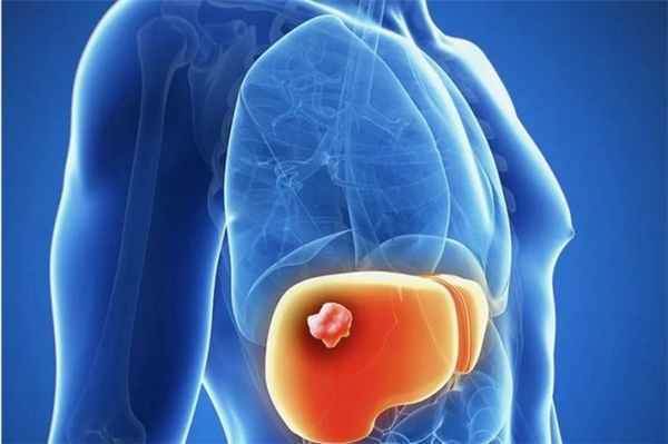 Гемангиома печени