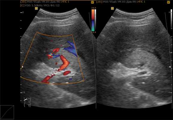 узи гемангиомы печени