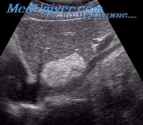 гемангиома печени