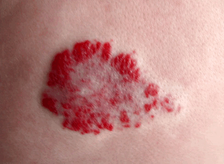 Младенческая гемангиома