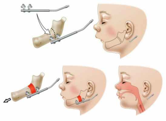 Дистракционный остеогенез нижней челюсти