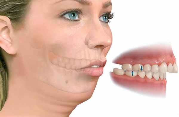 Дистальный прикус: скошенный подбородок со складками