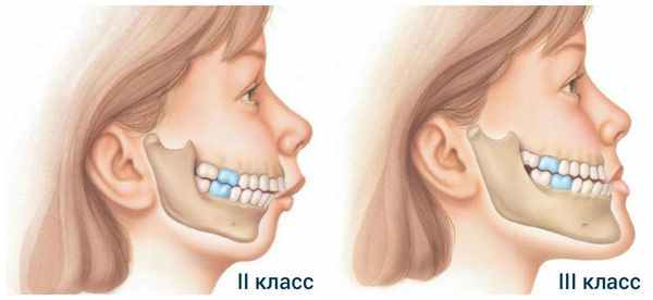 Классы дисгнатии