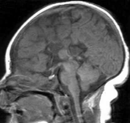 gaicardi_syndrome_fig1a