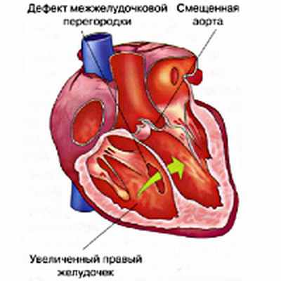Тетрада Фалло