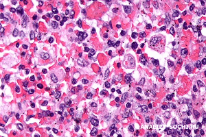 Гемофагоцитарный лимфогистиоцитоз