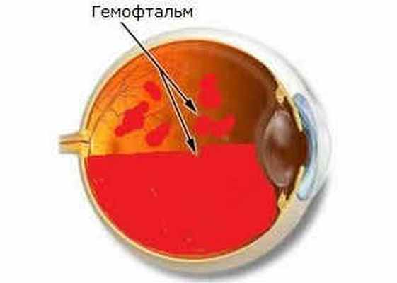 Частичный и полный гемофтальм глаза