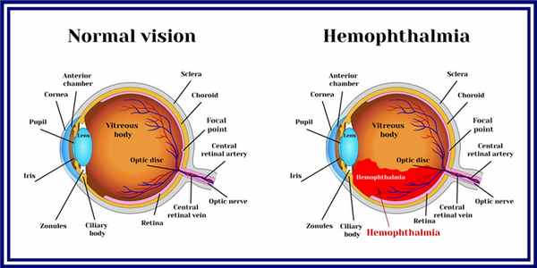 кровоизлияние в стекловидное тело