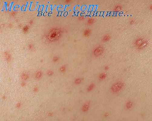 геморрагические вазопатии